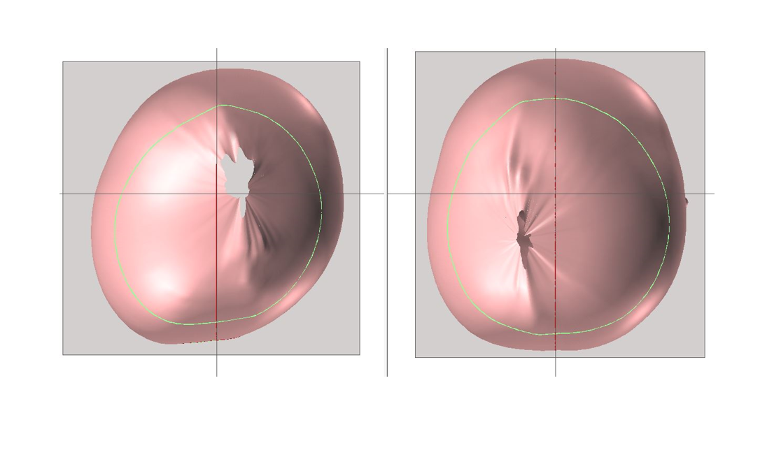 Cranial remolding